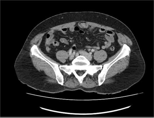 CT abdomen/pelvis in axial view, demonstrating a mildly thickened appendix and a small appendiceal diverticulum.