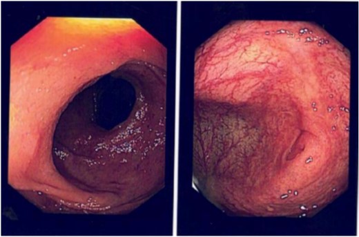 Colonoscopy performed 2 months following appendectomy demonstrating no abnormalities.