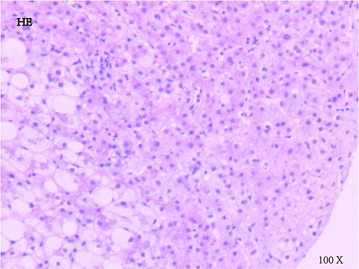 Liver biopsy showed moderate cholestatic hepatitis.