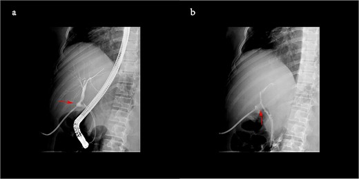 The biliary tract contrast during ERCP showed a slight distortion of duct (a), and one plastic biliary stent was placed to mitigate the distortion (b).