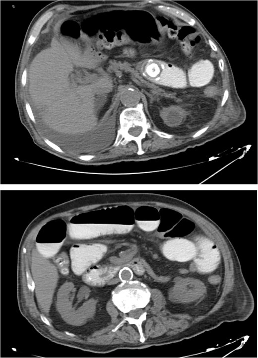 CT images of the abdomen revealed small bowel obstruction due to gallstone and presence of air and oral contrast into the gallbladder.