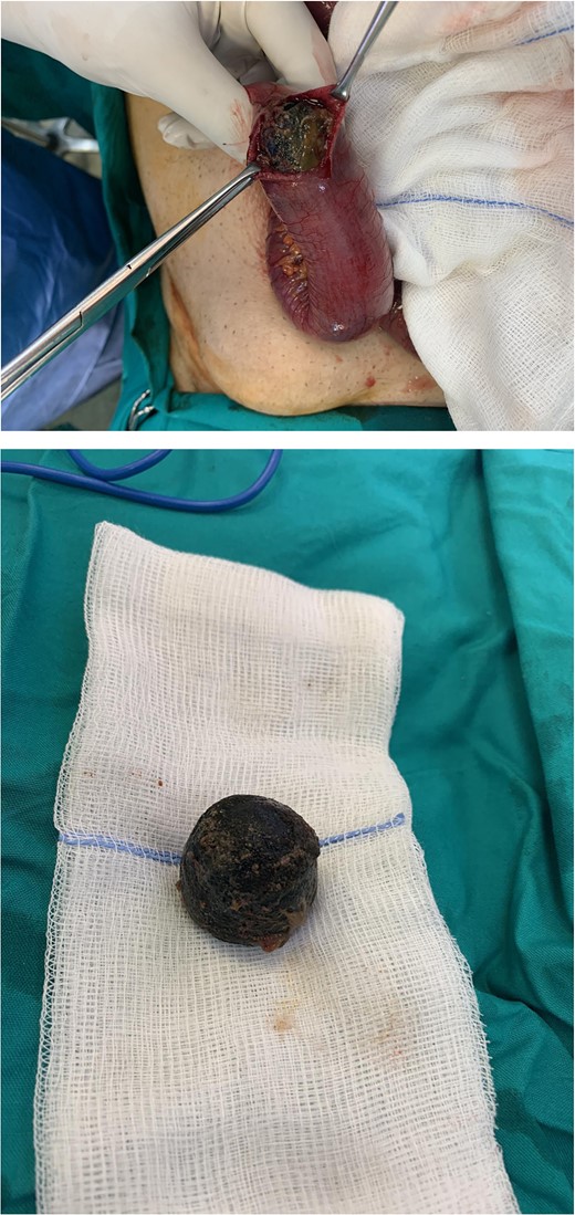 Intraoperative photo of a spherical gallstone of 3 cm in diameter extracted from an ileum intestinal loop.