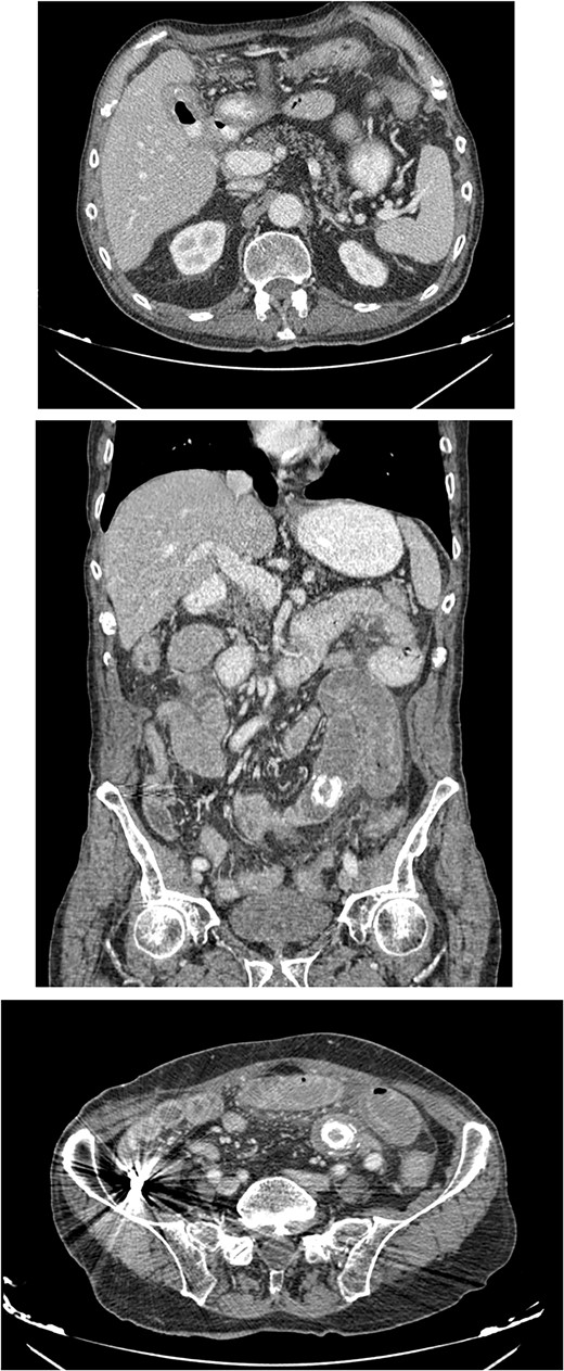 CT images with oral and IV contrast revealed presence of air and oral contrast in the gallbladder and small bowel obstruction caused by a mass in the jejunum–ileum transition attributed to a gallstone.