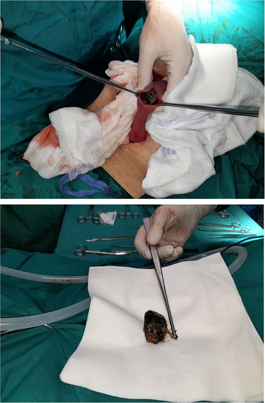 Intraoperative images of a 4 cm × 2 cm gallstone extracted from an ileum intestinal loop.