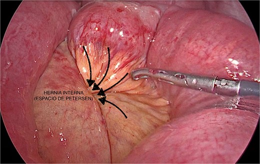 Laparoscopic visualization of Petersen’s hernia.