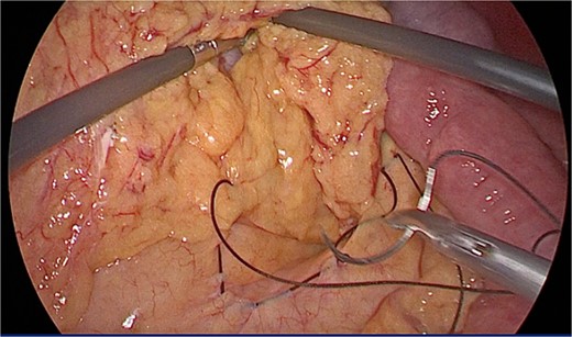 Repair of Petersen’s hernia with 2–0 silk sutures.