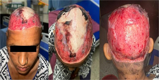 Near complete scalp avulsion at time of presentation.