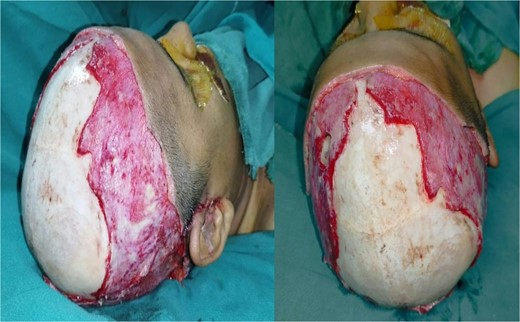 Exposed raw area following debridement.
