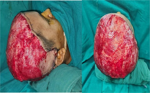 Coverage of scalp defect using latissimus dorsi free flap.