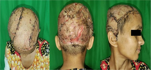 Successful uptake of STSG.