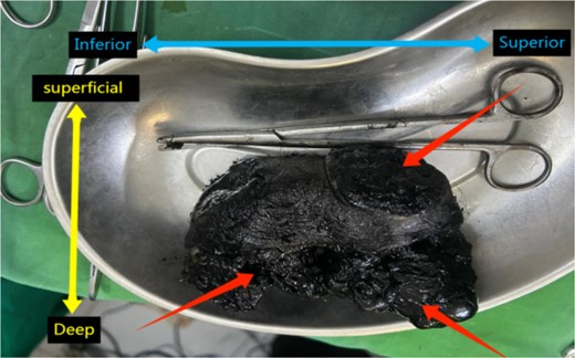 Specimen of ILND showing an enlarged black pigmented LN. Anatomical orientation is indicated with “Superior,” “Inferior,” “Superficial,” and “Deep” labeled.