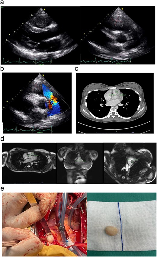 (a) The parasternal long-axis view of transthoracic ECHO showing a well-defined mass, measuring ~ (2.0 × 2.0 cm) at the right ventricle. (b) The transthoracic ECHO colour flow Doppler showed significant pulmonary valve stenosis with potential Right ventricular outflow tract obstruction caused by the intracardiac mass. (c) The axial cut of a contrast-enhanced computed tomography (CECT) thorax showed a well-defined mass measuring ~ (2 cm × 2 cm) inside the RV. (d) The cardiac magnetic resonance imaging (MRI) confirmed the diagnosis of right RV myxoma by showing a well-defined hypointense mass measuring ~ (1.7 × 2.0 cm). (e) The tumour was identified and excised via a median sternotomy, bicaval cannulation, cardiopulmonary bypass, hypothermia, and cardiac arrested via antegrade cold-blood cardioplegia. The tumour was excised via a pulmonary arteriotomy approach. The tumour is well-defined, firm in consistency, and smooth surface. The size is ~ (2 cm × 2 cm).