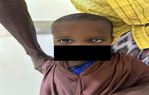 Leukocoria and esotropia of the left eye for 3 months.