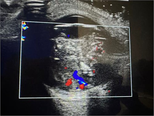 Left eye hyperecogenic mass.