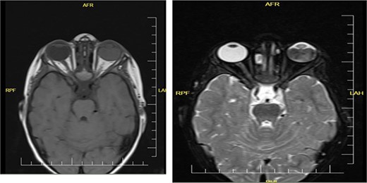 Coronal orbital MRI of t1 and t2 shows left intraocular tumor with vitreous seeding.