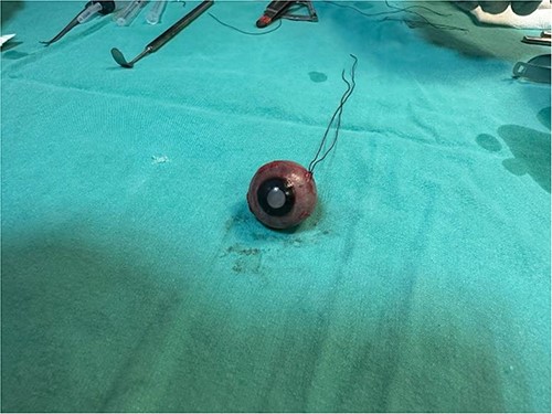 We send enucleated eye in the pathology department.