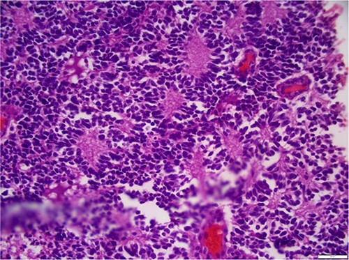 Hyperchromatic small round blue cells with scant cytoplasm arranged in sheets, nests, and Flexner–Wintersteiner rosettes.