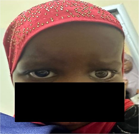 We put the patient for prosthetic eye for psychological support and cosmetic purpose.