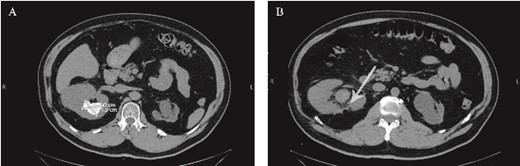 (A) Preoperative non-contrast CT scan showing a renal stone measuring 4.5*4 cm. (B) Postoperative non-contrast CT scan. The arrow points to the area from which the pseudoaneurysm most-likely originated postoperatively.