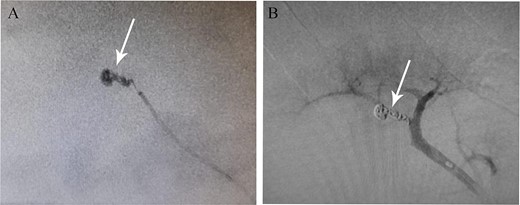 (A) Pseudoaneurysm seen on renal angiography. (B) The pseudoaneurysm following angioembolization.