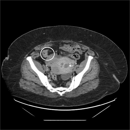 White arrow shows fluid in the uterus, black arrow shows phlegmon, and circle demonstrates colon and fistula.