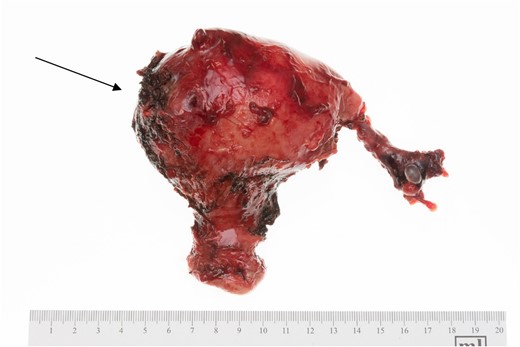 Uterus, cervix, and fallopian tube. The arrow marks the area of fistula formation.