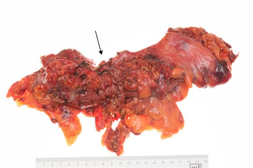 Sigmoid colon with arrow marking the area of fistula formation.