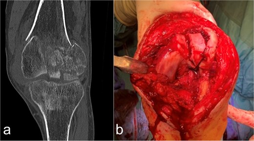 Case presentation of the knee region. (a) The coronal CT segment shows a transcondylar multifragment fracture of the femoral bone. (b) The intraoperative situs shows the comminuted zone of the condylar articular surface.