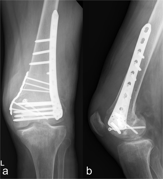 Treatment patterns of supra-intracondylar multifragment fracture (33C3.2). (a) The anterior-posterior and (b) lateral radiographs show a correct position of the osteosynthesis material with an nearly anatomical fracture position.