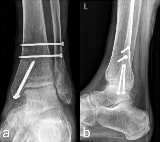 Treatment patterns of the distal tibia and Maisonneuve fracture (44C2.2 and Weber C). As a secondary finding, there is an osteopenic bone texture of the imaged skeletal area. (a) The anterior-posterior image shows an anatomical reposition of the medial malleolus, which was fixed with two lag screws. Two syndesmosis screws are located slightly further cranially. (b) The lateral image shows a continuous fragment adaptation of the medial malleolus/Vollkmann's triangle. The screws inserted at the level of the medial malleolus and proximal to the syndemosis tibiofibularis show a regular position.