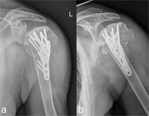 Treatment patterns of the subcapital humerus fracture (11C3.1). (a, b) The radiographs in two planes show extensive coverage of the fracture fragments with adequate stabilization of the multiple fragment fracture of the caput humeri, which was treated osteosynthetically using a PHILOS® plate and multiple screws.