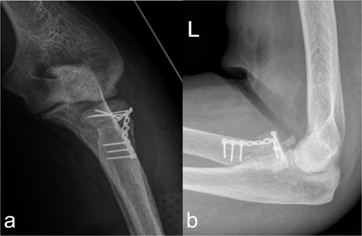 Treatment patterns of fractures of the caput and collum radii (2R1C3 and Mason stages II and III). (a, b) X-ray in two planes shows extensive coverage of the fracture fragments of the caput radii when the collum radii is straightened by the osteosynthesis material.