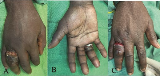 (A) Dorsal view showing circumferential ulcer with ring buried on the right ring finger, (B) ventral view showing entrapped ring, and (C) after ring removal and wound debridement.