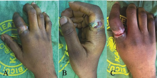 (A) Dorsal view showing right index finger with ring buried within granulation tissue, (B) lateral view showing circumferential ulceration, and (C) after ring removal.