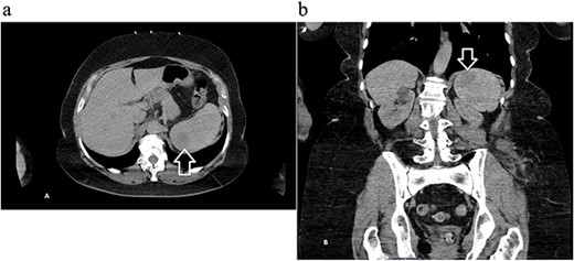 Computed tomography of the abdomen and pelvis with contrast showing an indeterminate round 3.5 cm hypo-attenuating lesion in the spleen: (a) axial and (b) coronal views with arrow marking the mass.