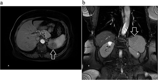 Magnetic resonance imaging of the abdomen with contrast showing a well-circumscribed 3.7 × 3.7 cm solid lesion in the lower pole of the spleen with a decreased signal on T2 on (a) axial and (b) coronal views with arrow marking the mass.