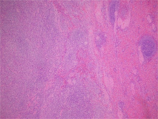 A well-circumscribed, nonencapsulated mass displaying mixed inflammatory elements (hematoxylin & eosin 40X).