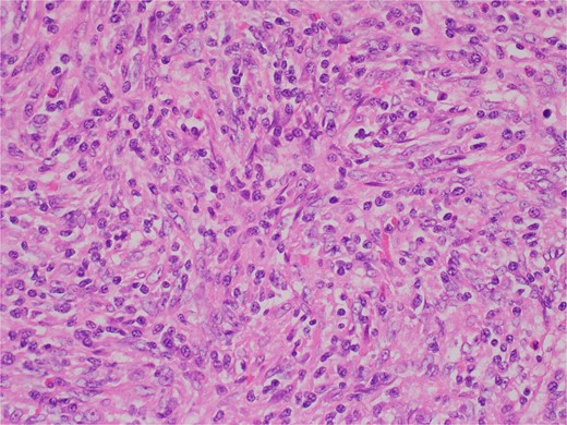 Variably increased stromal/spindled cells were noted (hematoxylin & eosin 400X).