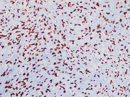 An atypical, spindled population is highlighted by CISH for EBER (EBER in situ hybridization 400X).