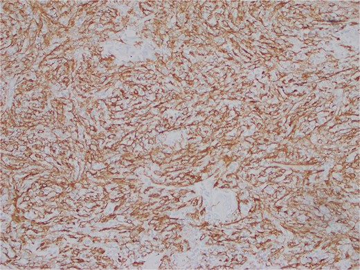 Atypical, spindled population is highlighted by clusterin (Clusterin 400X).