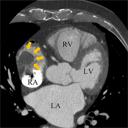 Preoperative enhanced computed tomography imaging showing a 25-mm intra-cardiac mass in the RA (arrows). RV, right ventricle; LA, left atrium; LV, left ventricle.