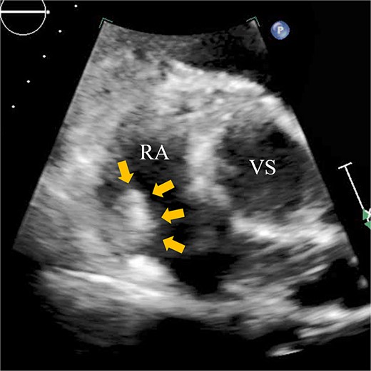 Transthoracic echocardiography showing a right atrial mass measuring 17 × 19 mm with slight mobility (arrows). VS, Valsalva sinus.