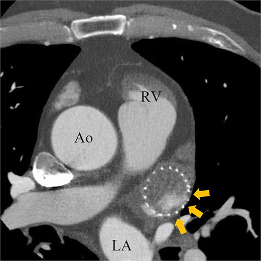 Preoperative enhanced computed tomography imaging showing peri-device leakage around the WATCHMAN (arrows). Ao, aorta.
