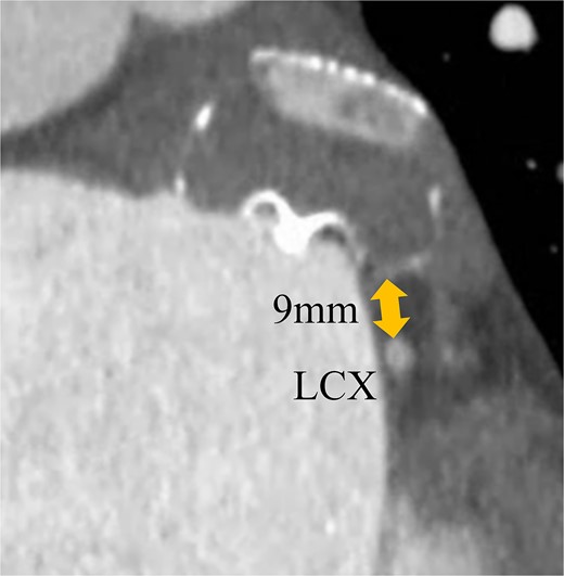 Preoperative enhanced computed tomography imaging showing the distance between the WATCHMAN device and the LCX was ~9 mm.