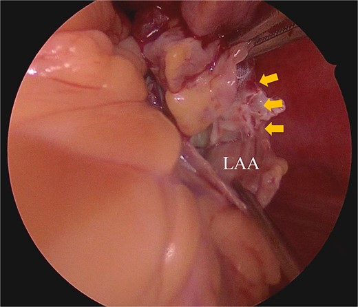 Intraoperative finding shows that the piece of WATCHMAN device can be shown from an external incision of LAA.