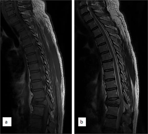 Sagittal T1 (a) and T2 (b) weighted thoracic MRI images showing collapsed T11 vertebral body and tumour involvement of the T11 spinous process.