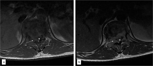 Axial T1 pre (a) and post (b) contrast thoracic spine MRI showing contrast-enhancing extradural tumour (arrow) compressing the spinal cord (asterisk).