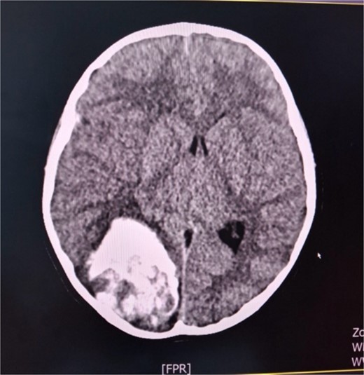 Axial cerebral CT scan shows massive hemorrhaging tumor in the right occipital region with perifocal oedema.