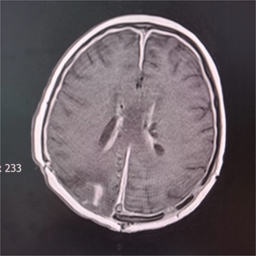 Cerebral MRI. Axial T1 weighted MRI showing ventriculitis with two external ventricular drainages (EVD) in the frontal horns of lateral ventricles.