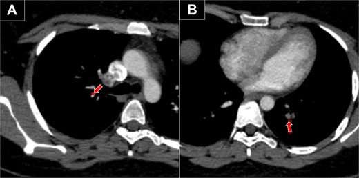 Chest CT with bilateral PE. (A) Embolism in the segmental artery of the right upper lobe (arrow). (B) Embolism in the posterior segmental artery of the left lower lobe (arrow).
